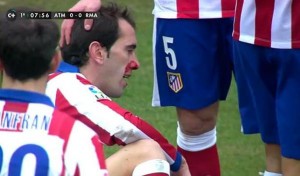 Diego Godín jugó TODO el partido con los huesos de la nariz roto. Hablale de huevos al uruguayo...