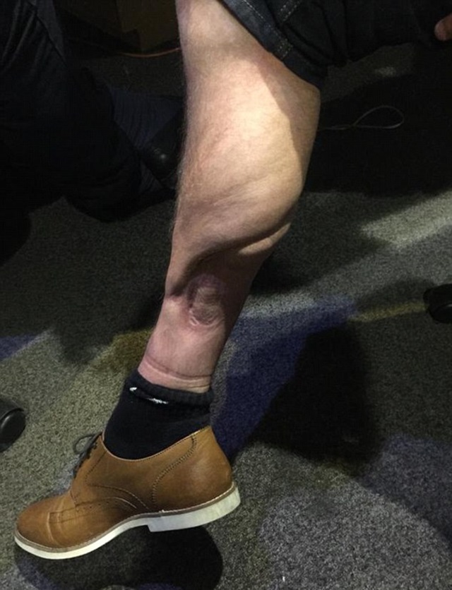 David Busst muestra imágenes de su escalofriante lesión Leer más en: http://www.sportyou.es/blog/futbol/2015/07/27/david-busst-lesion-pierna-556928.html